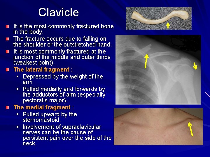 Clavicle It is the most commonly fractured bone in the body. The fracture occurs