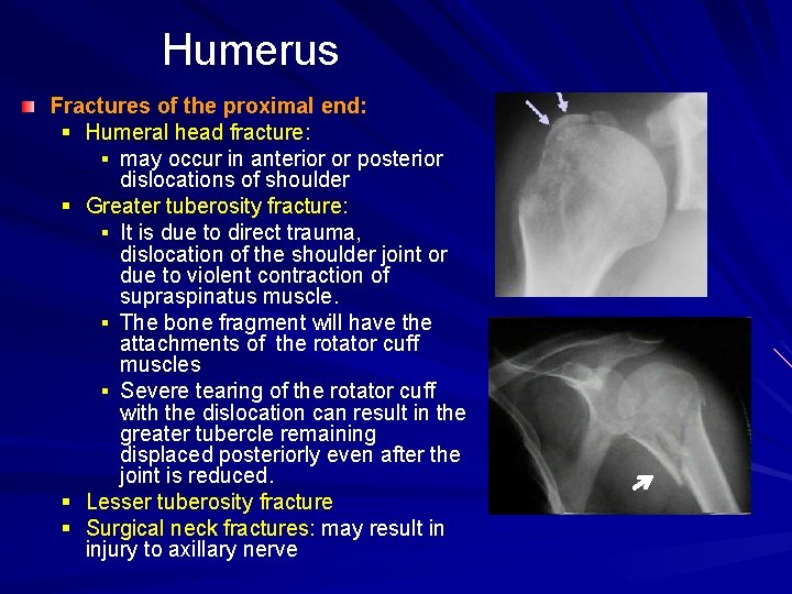 Humerus Fractures of the proximal end: § Humeral head fracture: § may occur in
