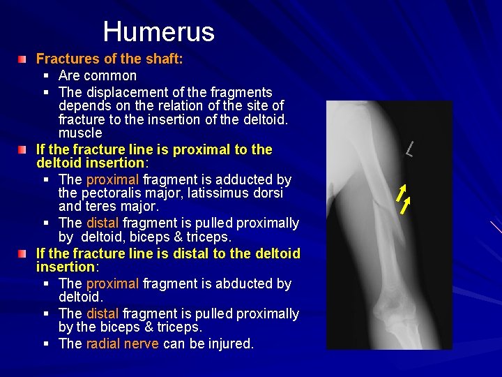 Humerus Fractures of the shaft: § Are common § The displacement of the fragments