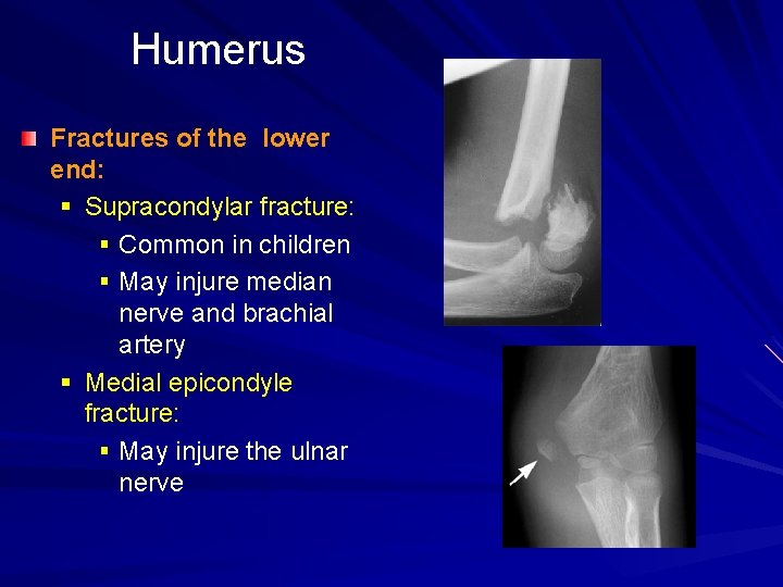 Humerus Fractures of the lower end: § Supracondylar fracture: § Common in children §