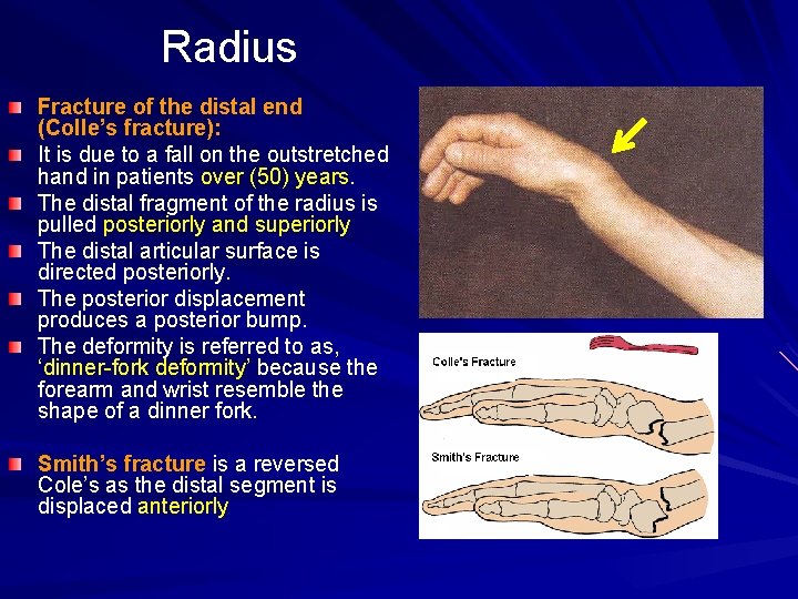 Radius Fracture of the distal end (Colle’s fracture): It is due to a fall