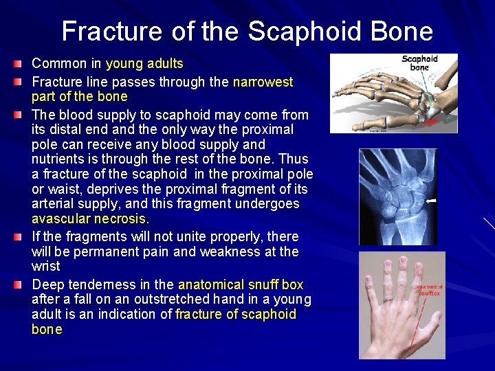 Fracture of the Scaphoid Bone Common in young adults Fracture line passes through the
