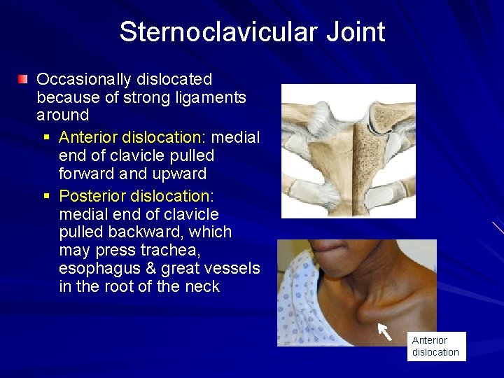 Sternoclavicular Joint Occasionally dislocated because of strong ligaments around § Anterior dislocation: medial end
