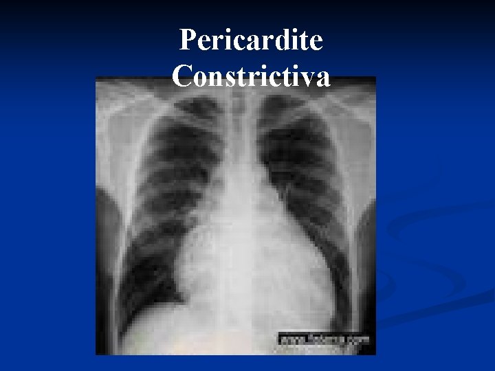 Pericardite Constrictiva 