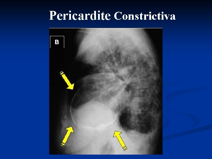 Pericardite Constrictiva 