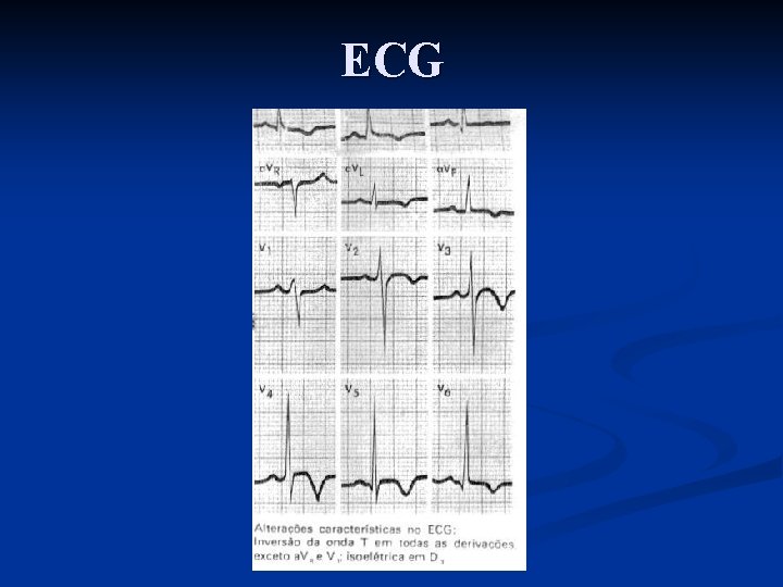 ECG 