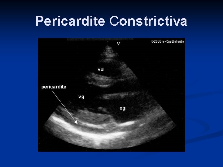 Pericardite Constrictiva 