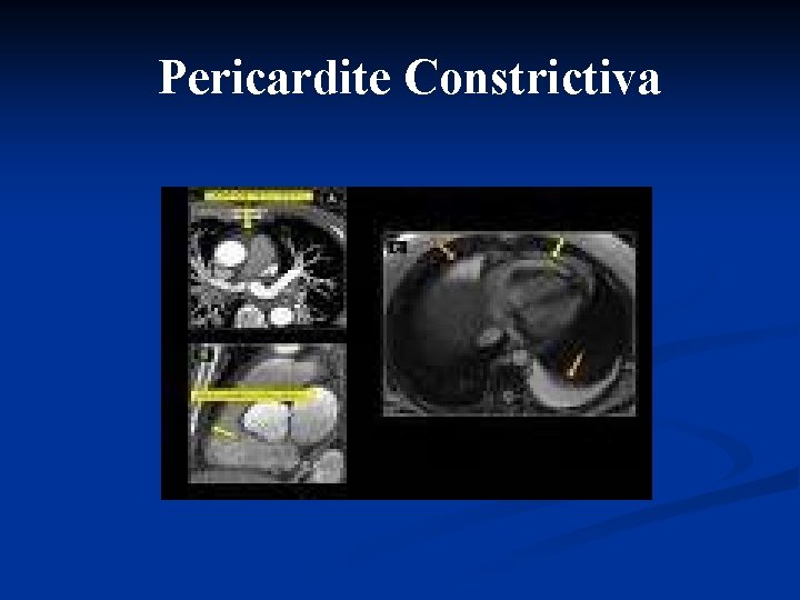 Pericardite Constrictiva 