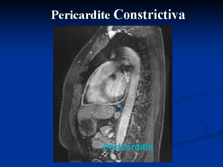 Pericardite Constrictiva 
