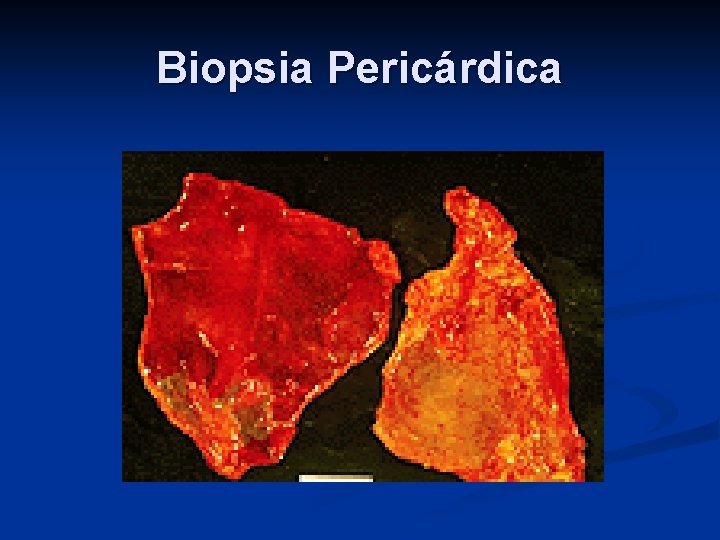 Biopsia Pericárdica 