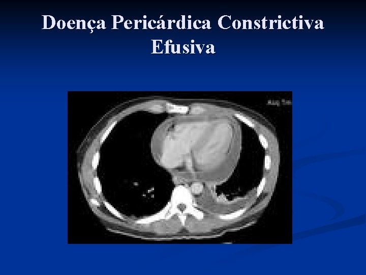 Doença Pericárdica Constrictiva Efusiva 