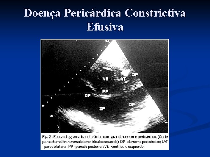 Doença Pericárdica Constrictiva Efusiva 