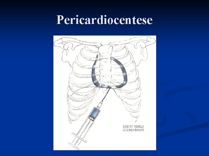 Pericardiocentese 