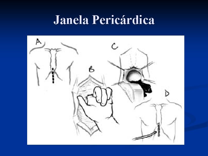 Janela Pericárdica 