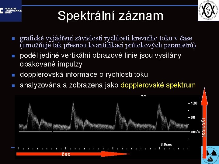 Spektrální záznam n n grafické vyjádření závislosti rychlosti krevního toku v čase (umožňuje tak