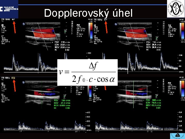 Dopplerovský úhel 