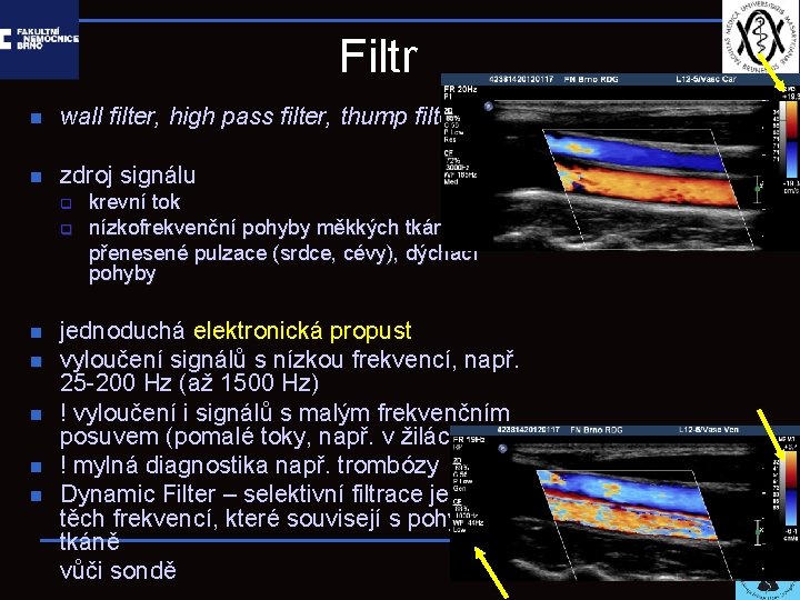 Filtr n wall filter, high pass filter, thump filter n zdroj signálu q q