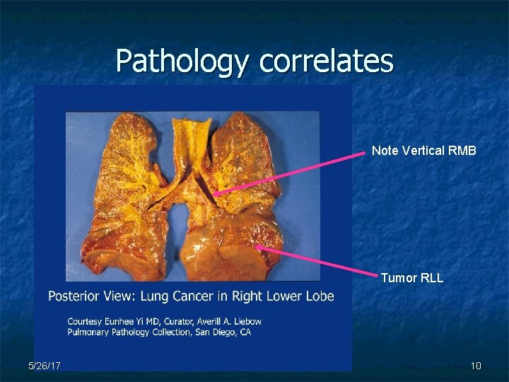 Pathology correlates Note Vertical RMB Tumor RLL 5/26/17 BI, All Rights Reserved, 2005 10