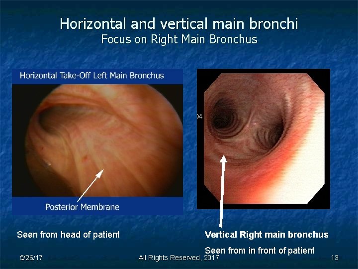 Horizontal and vertical main bronchi Focus on Right Main Bronchus Seen from head of