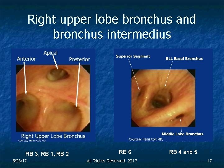 Right upper lobe bronchus and bronchus intermedius RB 3, RB 1, RB 2 5/26/17