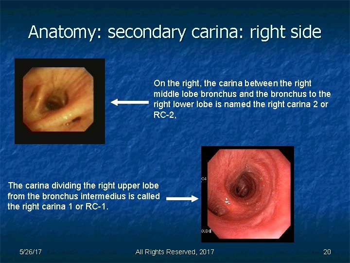 Anatomy: secondary carina: right side On the right, the carina between the right middle