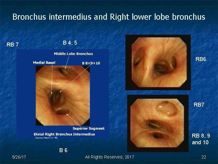 Bronchus intermedius and Right lower lobe bronchus RB 7 B 4, 5 RB 6