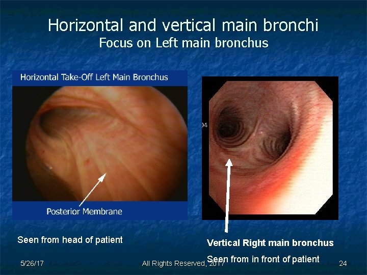 Horizontal and vertical main bronchi Focus on Left main bronchus Seen from head of
