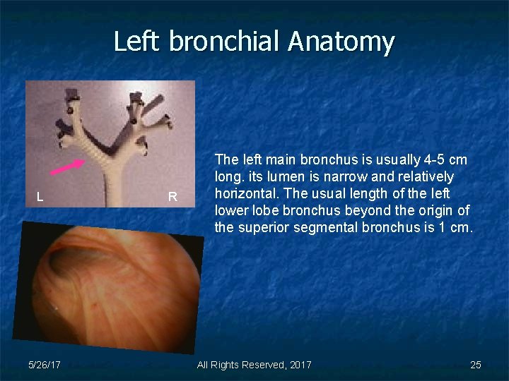 Left bronchial Anatomy L 5/26/17 R The left main bronchus is usually 4 -5