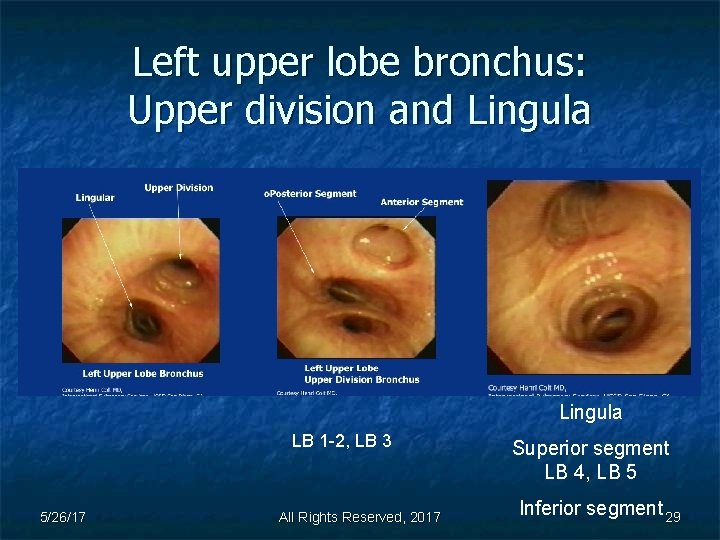 Left upper lobe bronchus: Upper division and Lingula LB 1 -2, LB 3 5/26/17