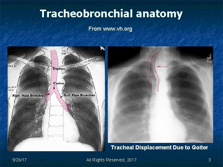 Tracheobronchial anatomy From www. vh. org Tracheal Displacement Due to Goiter 5/26/17 All Rights