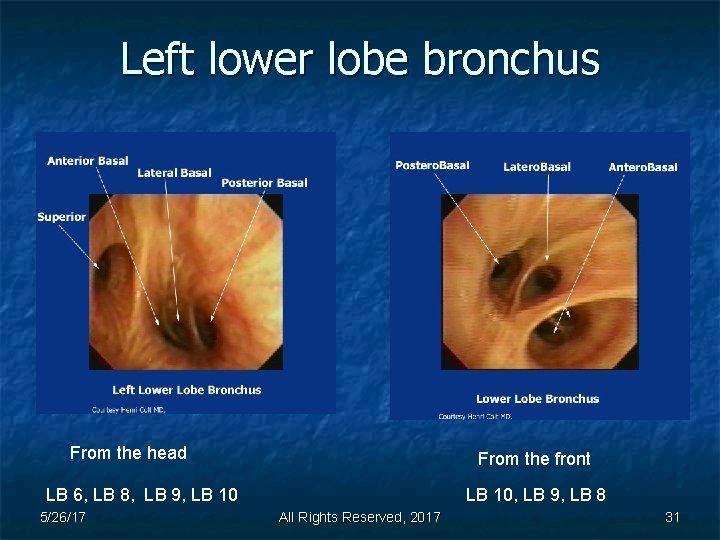 Left lower lobe bronchus From the head From the front LB 6, LB 8,