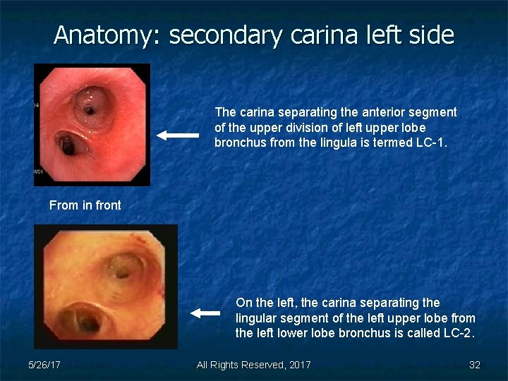 Anatomy: secondary carina left side The carina separating the anterior segment of the upper