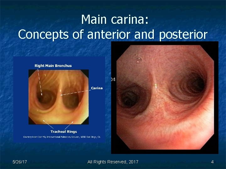 Main carina: Concepts of anterior and posterior 5/26/17 All Rights Reserved, 2017 4 