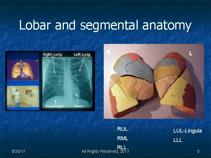 Lobar and segmental anatomy R 5/26/17 L RUL LUL-Lingula RML LLL RLL All Rights