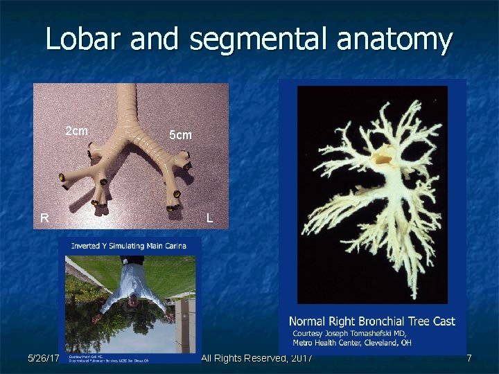 Lobar and segmental anatomy 2 cm R 5/26/17 5 cm L BI, All Rights