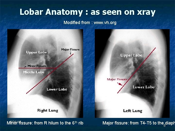 Lobar Anatomy : as seen on xray Modified from : www. vh. org 5/26/17
