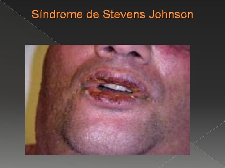 Síndrome de Stevens Johnson 