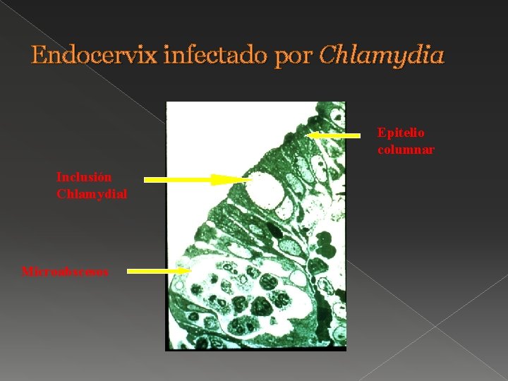 Endocervix infectado por Chlamydia Epitelio columnar Inclusión Chlamydial Microabscesos 