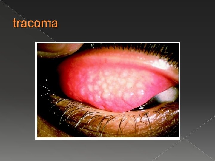 tracoma 