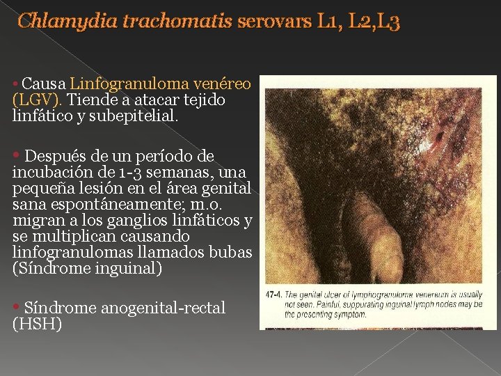 Chlamydia trachomatis serovars L 1, L 2, L 3 • Causa Linfogranuloma venéreo (LGV).