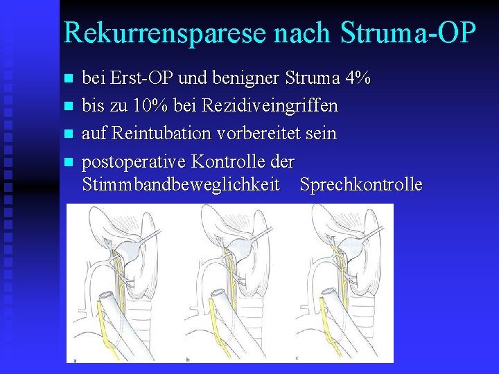 Rekurrensparese nach Struma-OP n n bei Erst-OP und benigner Struma 4% bis zu 10%