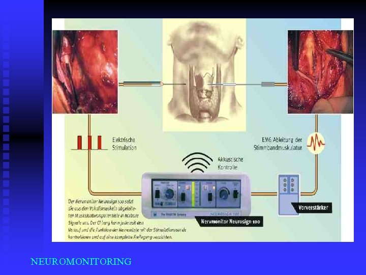 NEUROMONITORING 