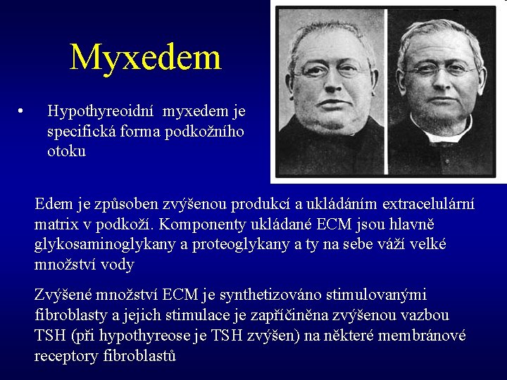 Myxedem • Hypothyreoidní myxedem je specifická forma podkožního otoku Edem je způsoben zvýšenou produkcí