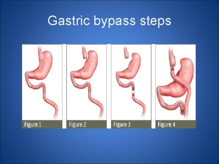 Gastric bypass steps 