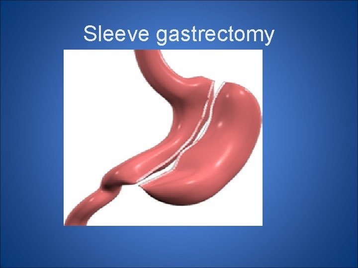 Sleeve gastrectomy Sleeve gastrectomy