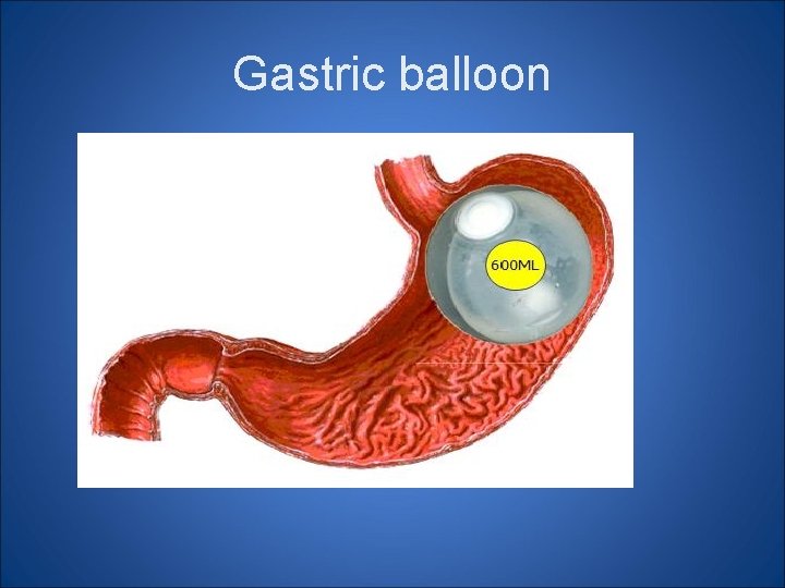 Gastric balloon 