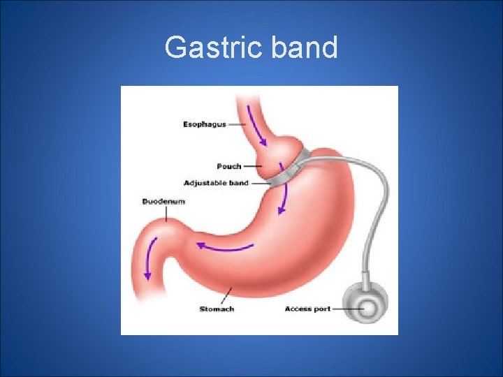 Gastric band Gastric band