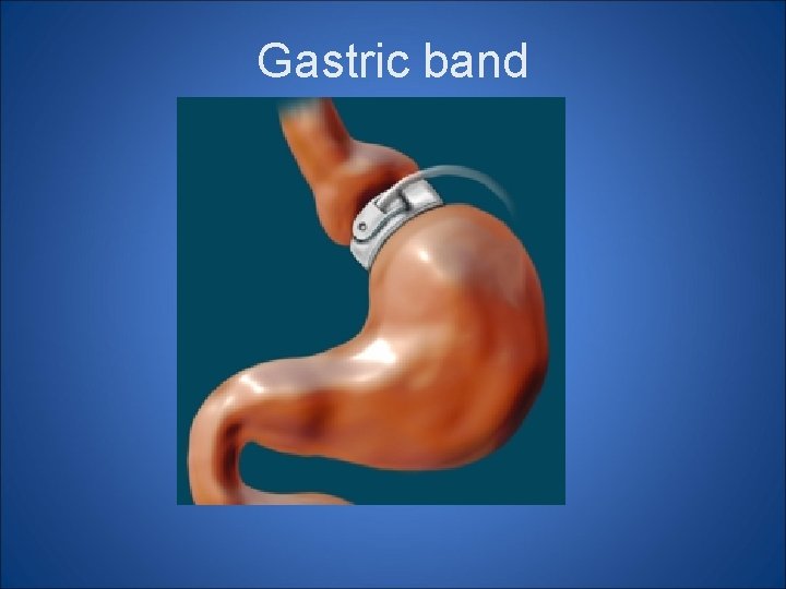 Gastric band Gastric band