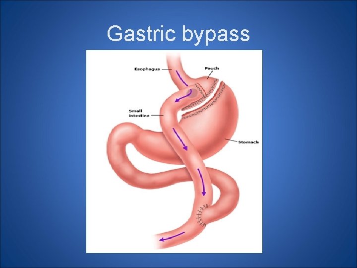Gastric bypass 