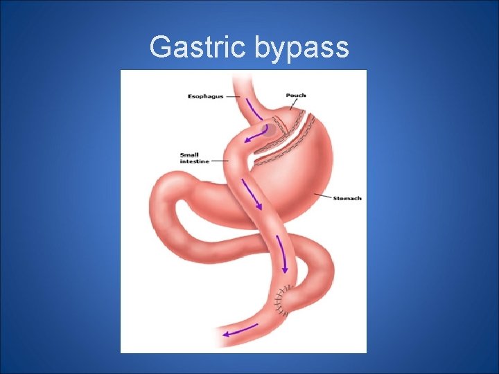 Gastric bypass Gastric bypass